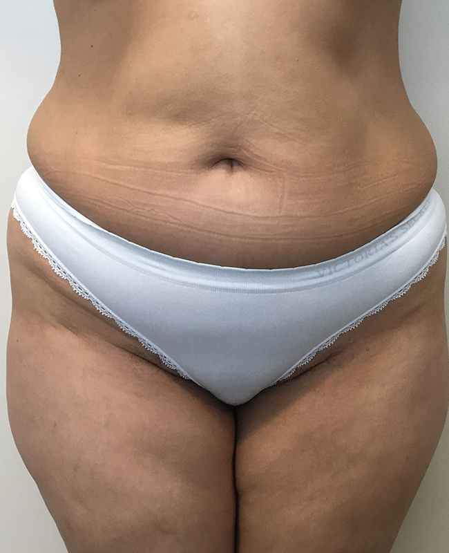 Abdominoplasty Before and After | Montilla Plastic Surgery 