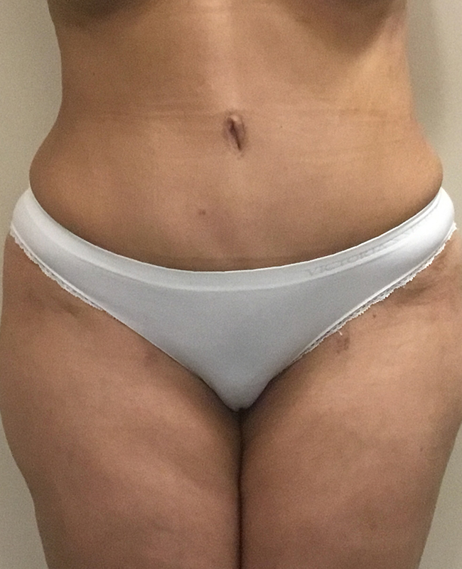 Abdominoplasty Before and After | Montilla Plastic Surgery 