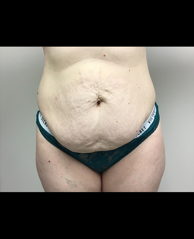 Abdominoplasty Before and After | Montilla Plastic Surgery 