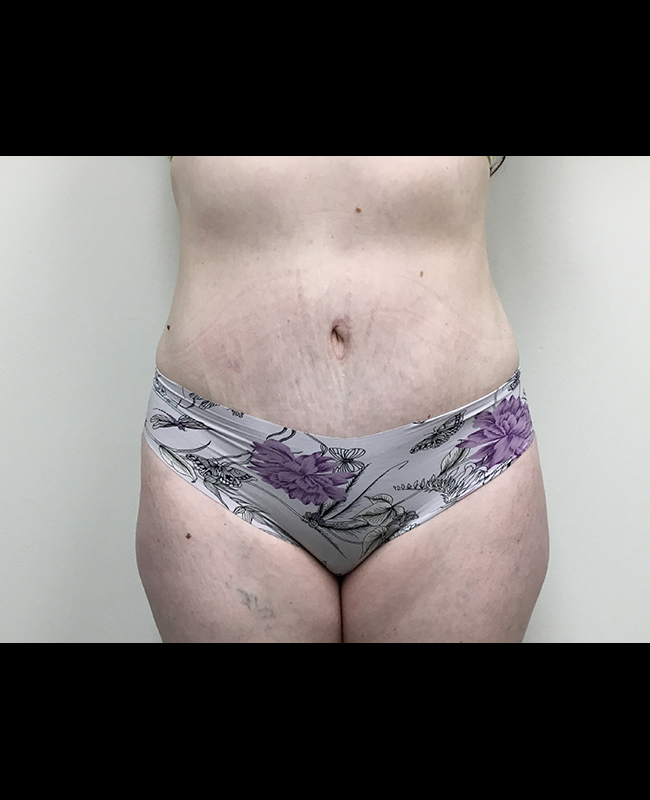 Abdominoplasty Before and After | Montilla Plastic Surgery 