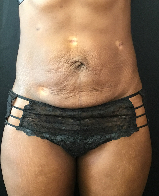Abdominoplasty Before and After | Montilla Plastic Surgery 
