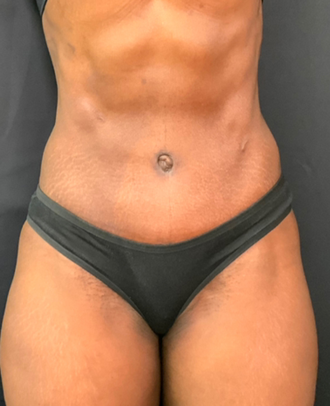 Abdominoplasty Before and After | Montilla Plastic Surgery 