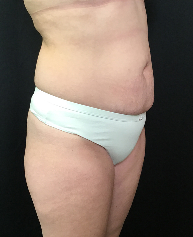 Abdominoplasty Before and After | Montilla Plastic Surgery 