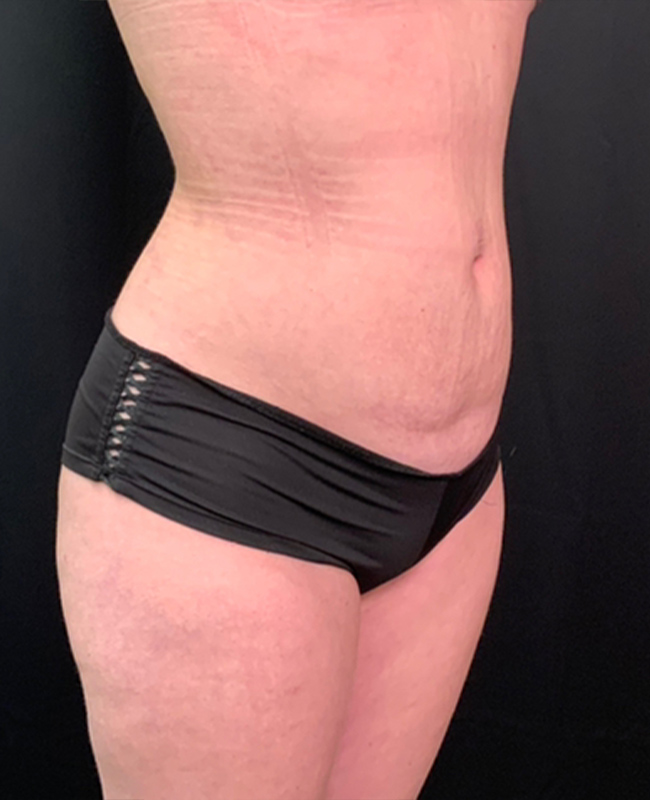 Abdominoplasty Before and After | Montilla Plastic Surgery 