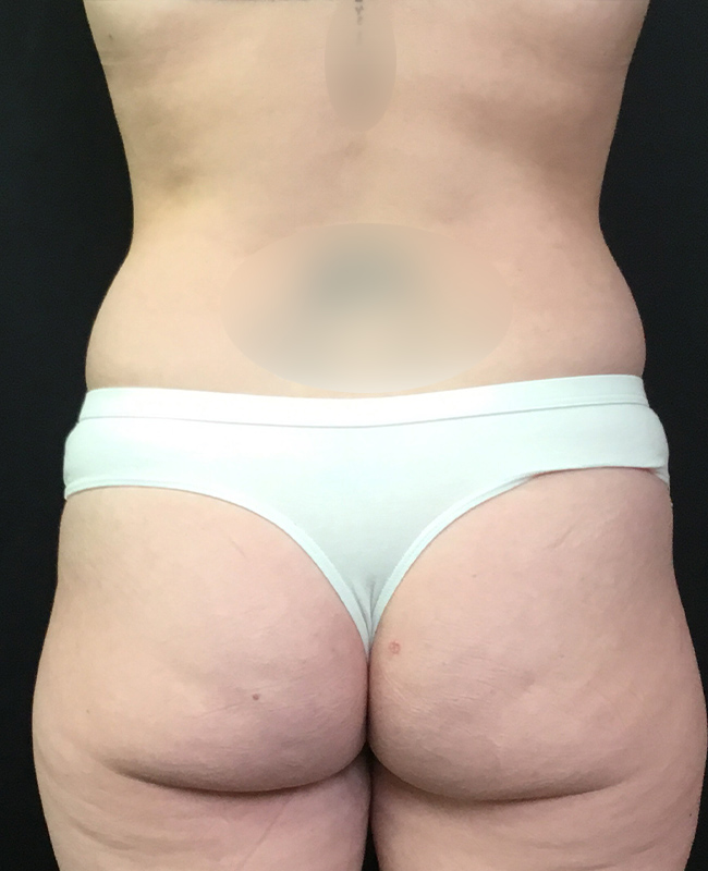 Abdominoplasty Before and After | Montilla Plastic Surgery 
