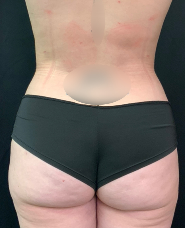 Abdominoplasty Before and After | Montilla Plastic Surgery 