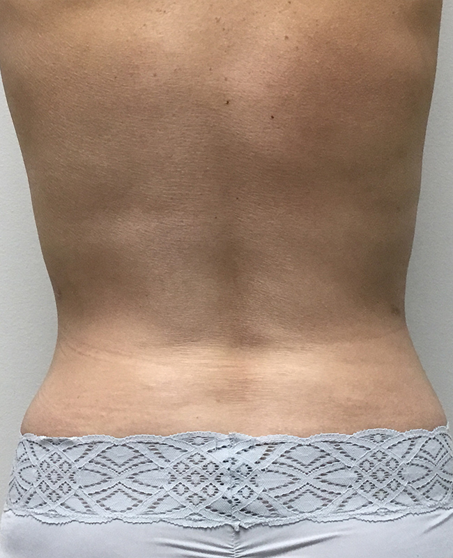Abdominoplasty Before and After | Montilla Plastic Surgery 