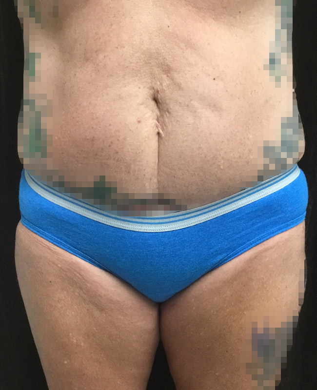 Abdominoplasty Before and After | Montilla Plastic Surgery 