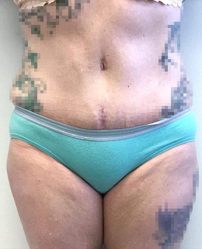 Abdominoplasty Before and After | Montilla Plastic Surgery 