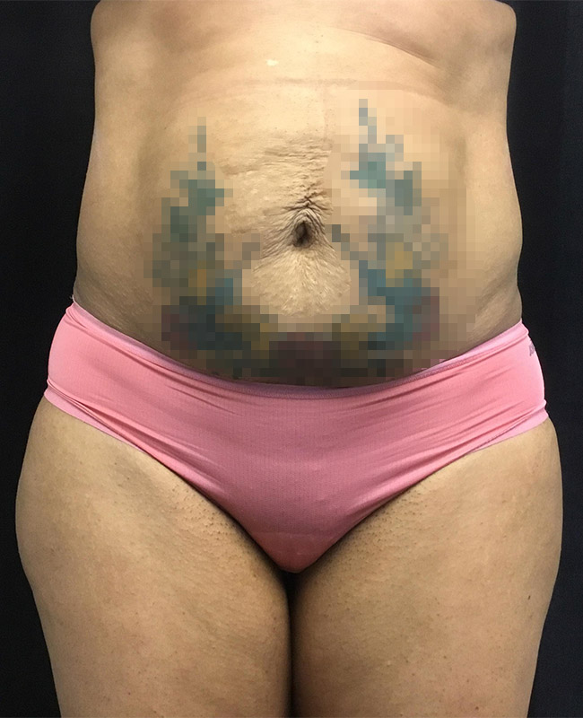 Abdominoplasty Before and After | Montilla Plastic Surgery 