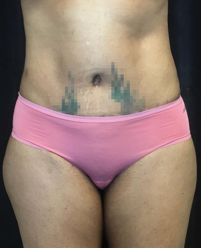 Abdominoplasty Before and After | Montilla Plastic Surgery 