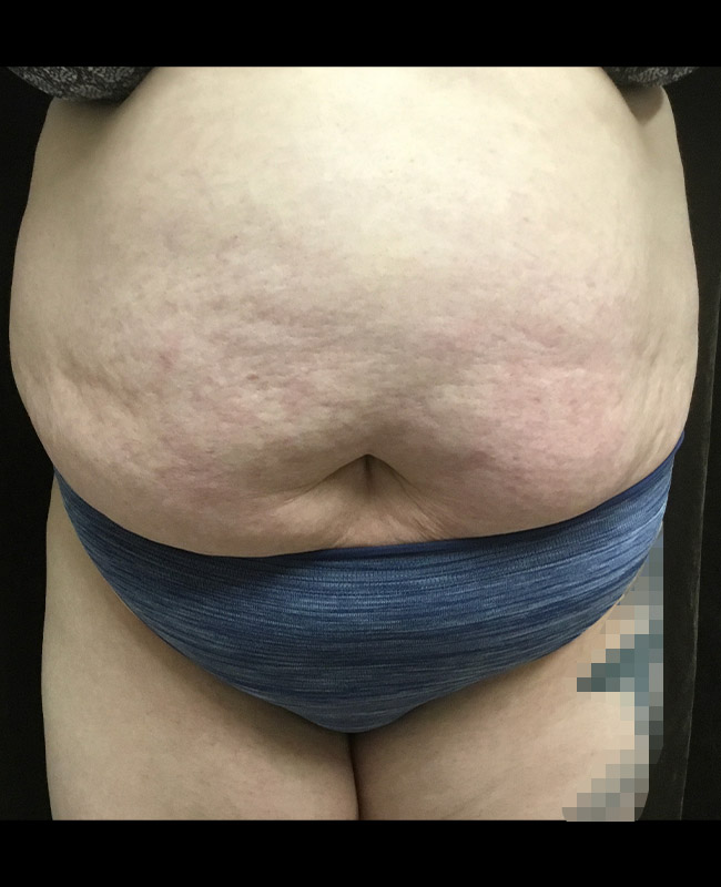 Abdominoplasty Before and After | Montilla Plastic Surgery 