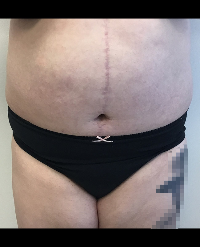 Abdominoplasty Before and After | Montilla Plastic Surgery 