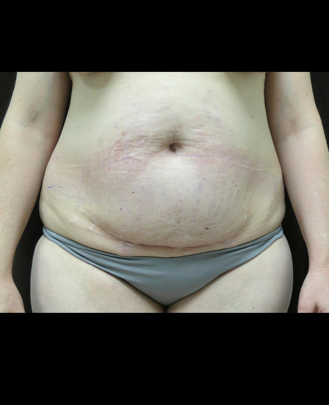 Abdominoplasty Before and After | Montilla Plastic Surgery 