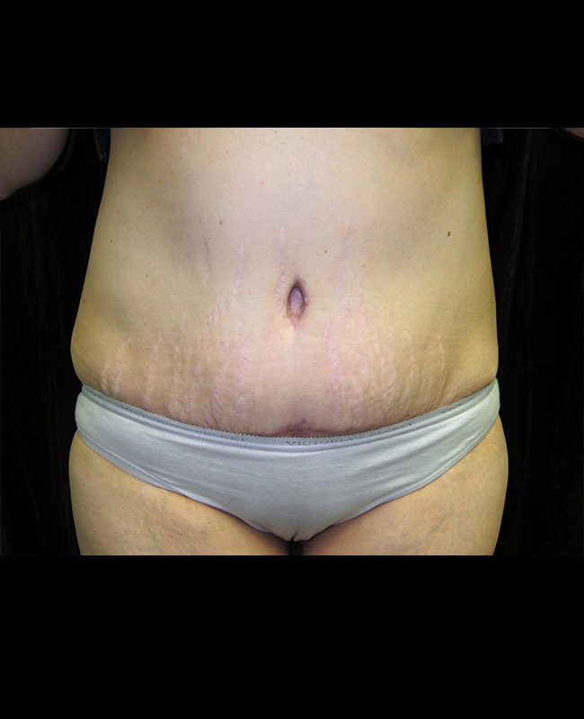 Abdominoplasty Before and After | Montilla Plastic Surgery 