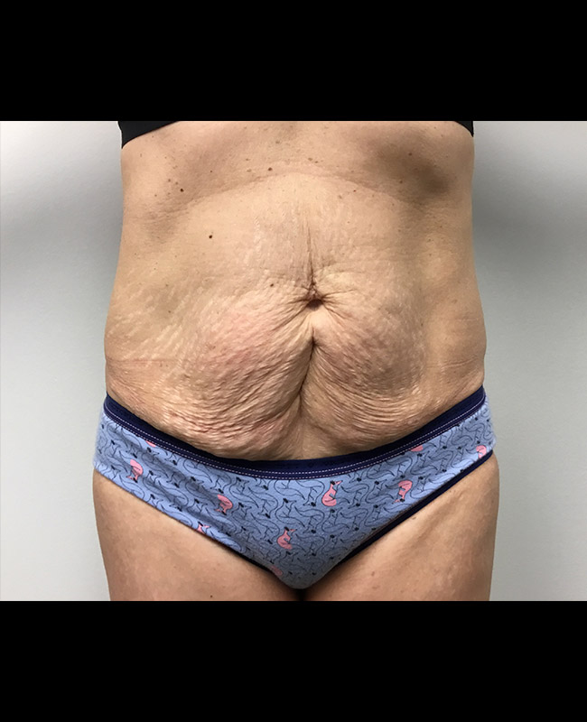 Abdominoplasty Before and After | Montilla Plastic Surgery 