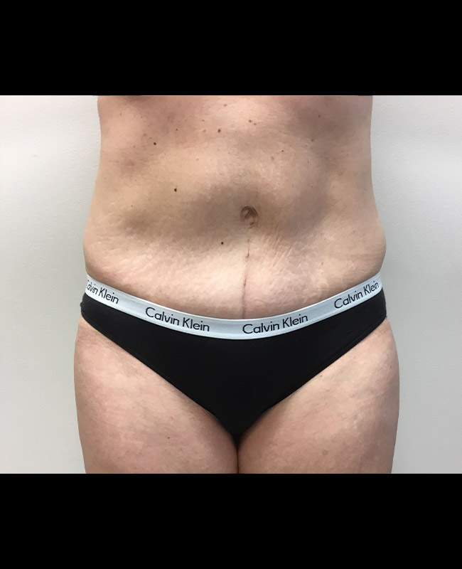 Abdominoplasty Before and After | Montilla Plastic Surgery 