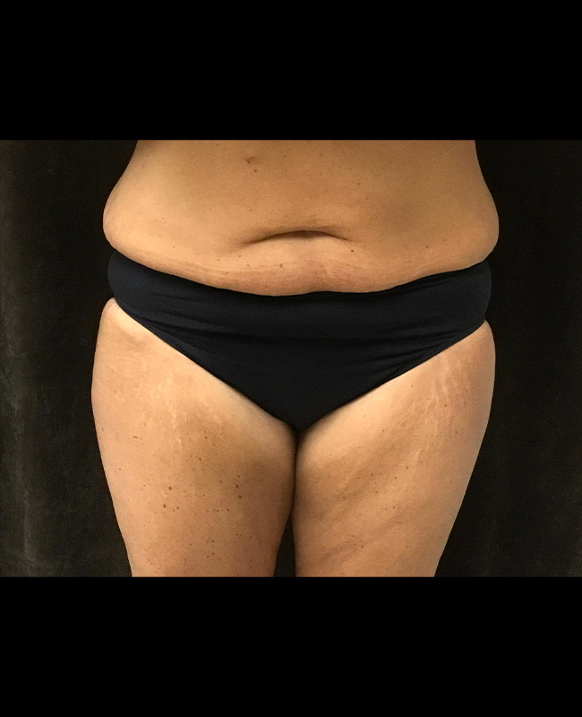 Abdominoplasty Before and After | Montilla Plastic Surgery 