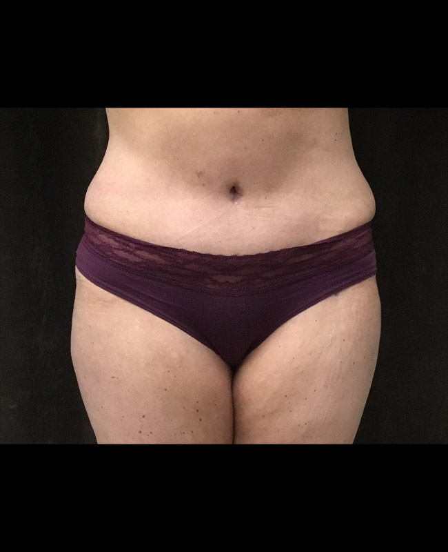 Abdominoplasty Before and After | Montilla Plastic Surgery 