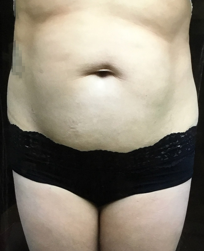 Abdominoplasty Before and After | Montilla Plastic Surgery 