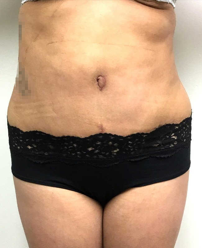 Abdominoplasty Before and After | Montilla Plastic Surgery 
