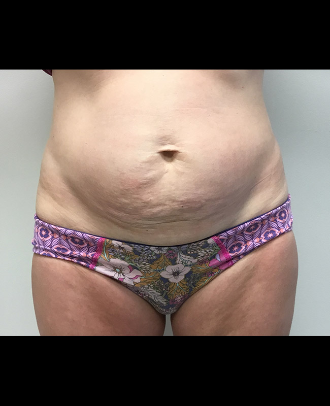 Abdominoplasty Before and After | Montilla Plastic Surgery 