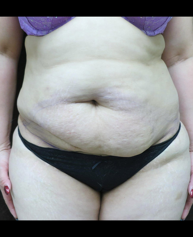 Abdominoplasty Before and After | Montilla Plastic Surgery 