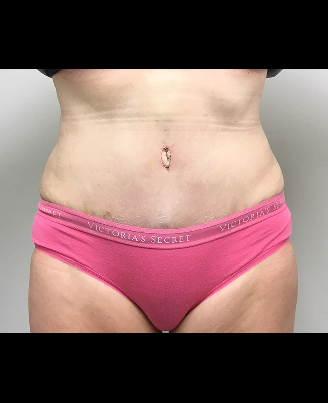 Abdominoplasty Before and After | Montilla Plastic Surgery