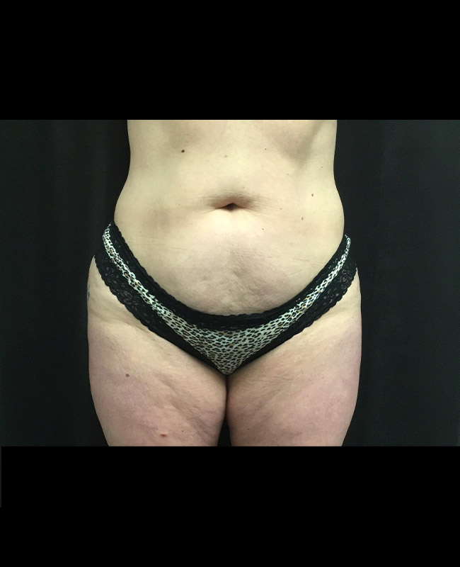 Abdominoplasty Before and After | Montilla Plastic Surgery 