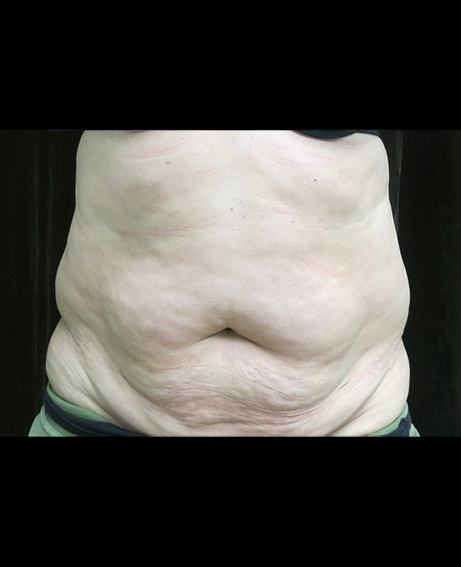 Abdominoplasty Before and After | Montilla Plastic Surgery 