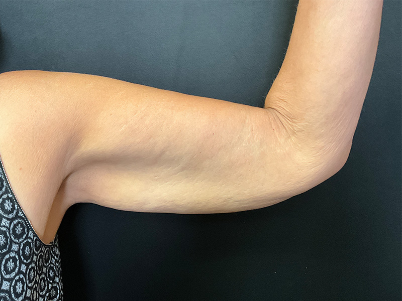 Arm Lift Before and After | Montilla Plastic Surgery