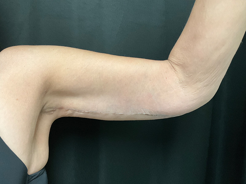 Arm Lift Before and After | Montilla Plastic Surgery