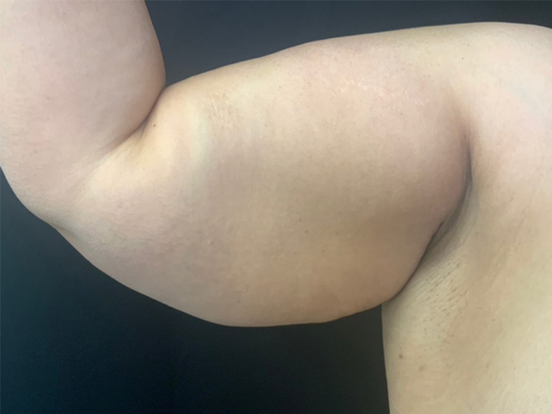 Arm Lift Before and After | Montilla Plastic Surgery