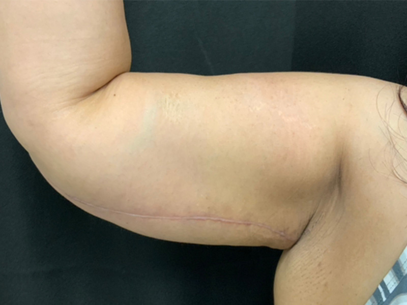Arm Lift Before and After | Montilla Plastic Surgery