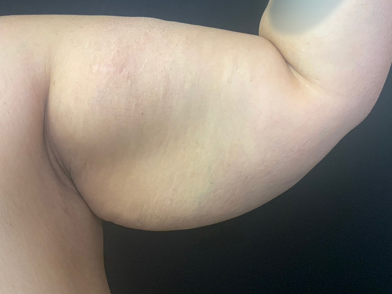 Arm Lift Before and After | Montilla Plastic Surgery