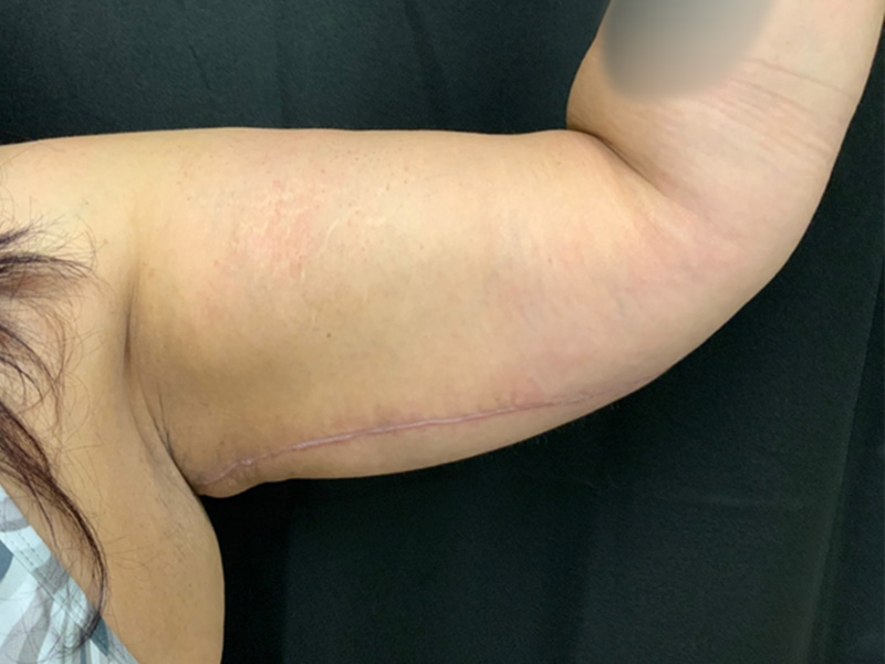 Arm Lift Before and After | Montilla Plastic Surgery