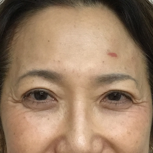 Botox Before and After | Montilla Plastic Surgery 
