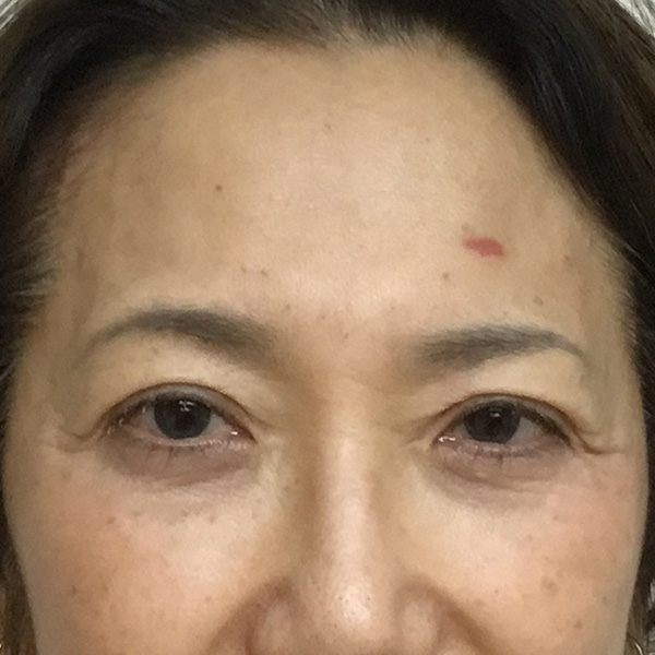 Botox Before and After | Montilla Plastic Surgery 