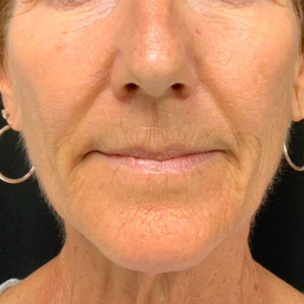 Botox Before and After | Montilla Plastic Surgery 
