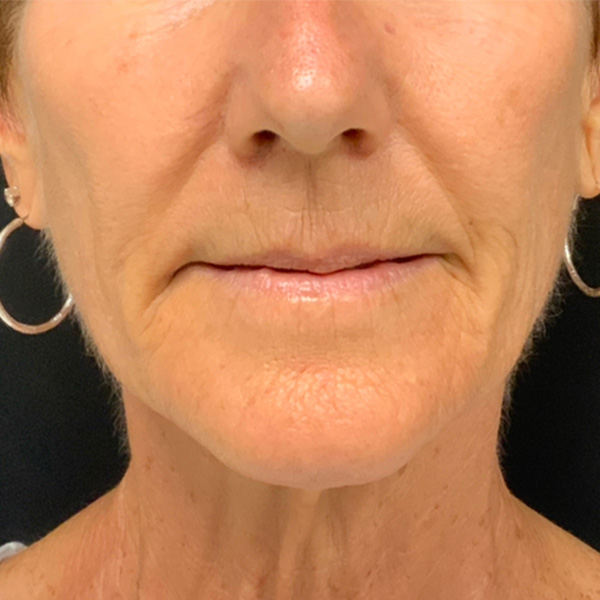 Botox Before and After | Montilla Plastic Surgery 