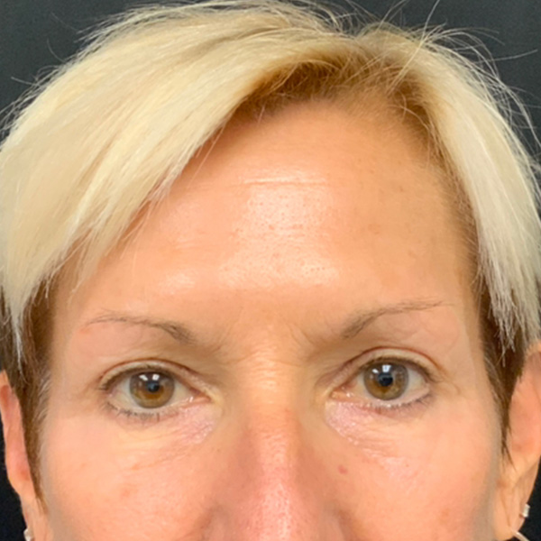 Botox Before and After | Montilla Plastic Surgery