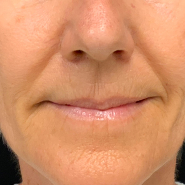 Botox Before and After | Montilla Plastic Surgery