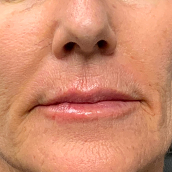 Botox Before and After | Montilla Plastic Surgery