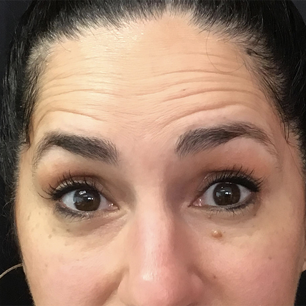 Botox Boston before 1