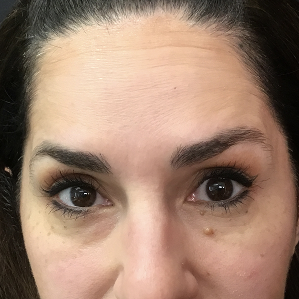 Botox Boston after 1