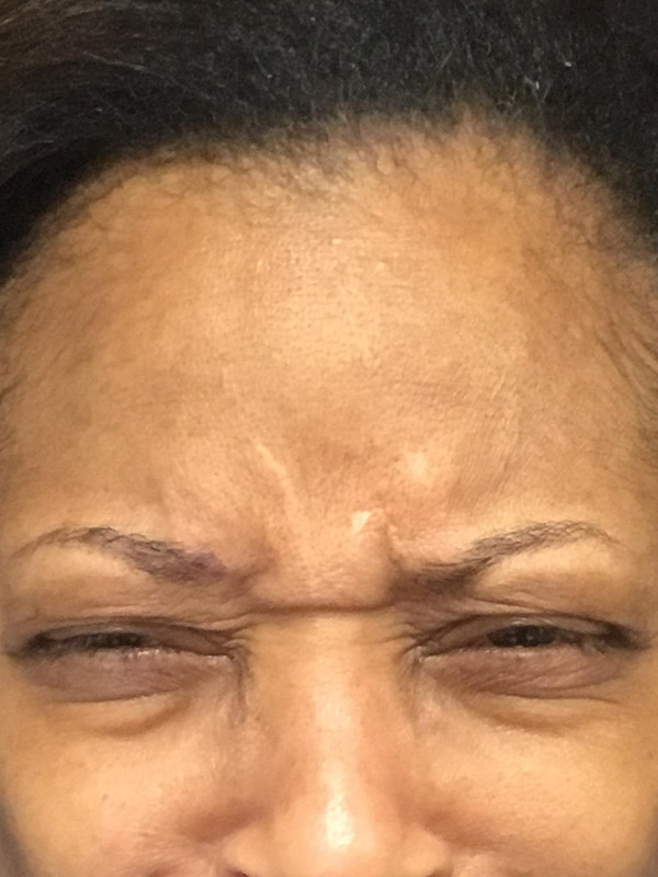 Botox Boston before 2