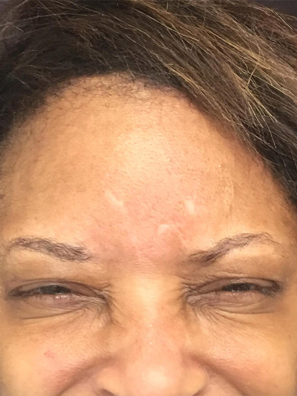 Botox Boston after 2