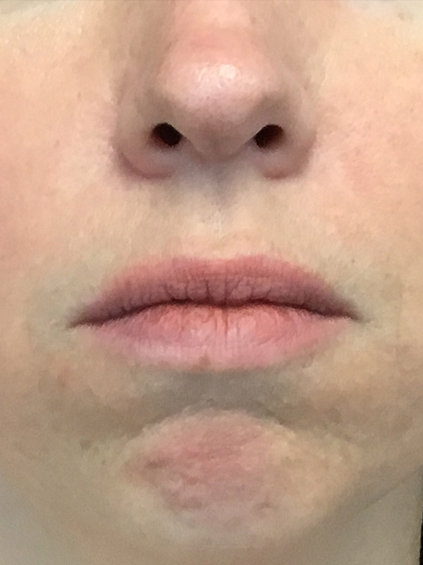 Botox Before and After | Montilla Plastic Surgery 