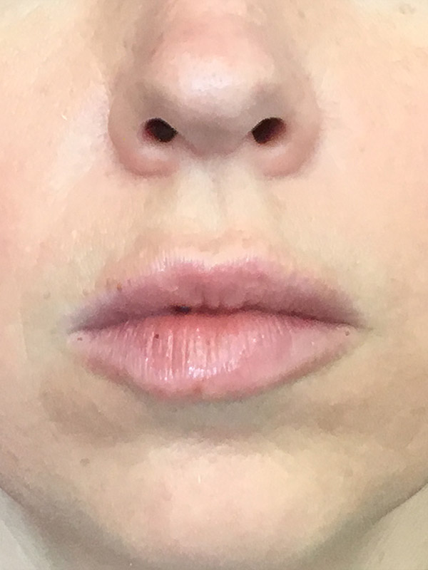 Botox Before and After | Montilla Plastic Surgery 