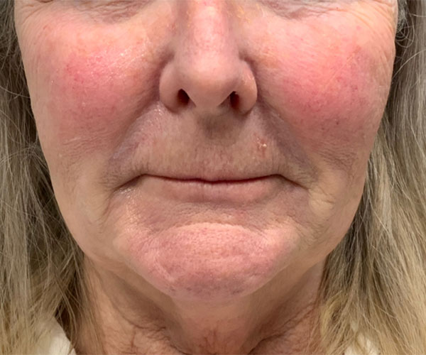 Botox Before and After | Montilla Plastic Surgery